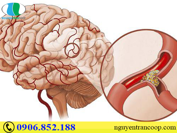 Nguyên nhân tai biến mạch máu não và cách phòng ngừa