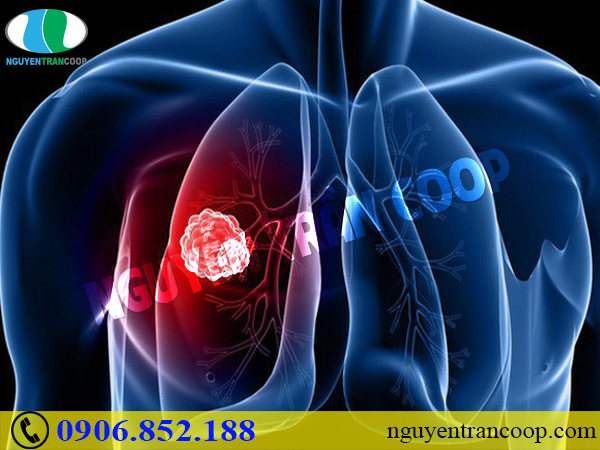Những sự thật không phải ai cũng biết về bệnh ung thư phổi