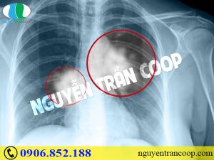 Những sự thật không phải ai cũng biết về bệnh ung thư phổi