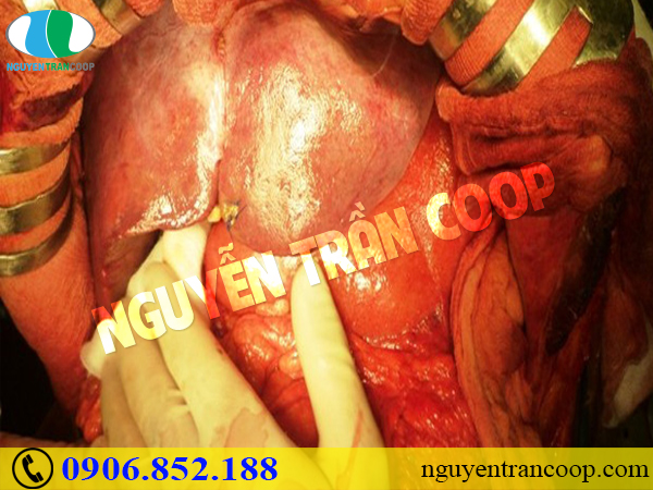 Những triệu chứng ung thư gan di căn là gì?