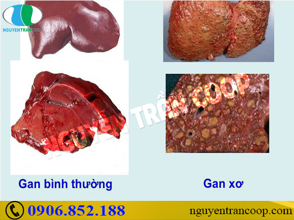 Tìm hiểu tác dụng Cây An Xoa chữa xơ gan