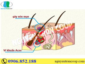 Tìm hiểu tận gốc nguyên nhân gây ra mụn (Phần 2)