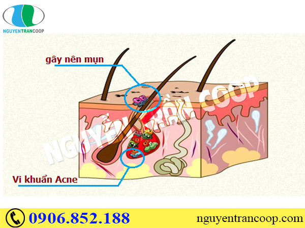 Tìm hiểu tận gốc nguyên nhân gây ra mụn (Phần 2)
