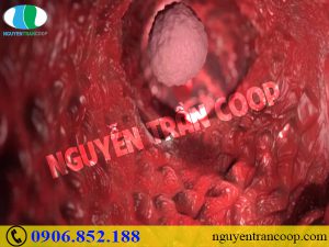 Ung thư di căn là gì? Có thể chữa khỏi được không?