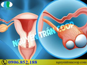 Xôn xao tác dụng Xáo Tam Phân chữa ung thư buồng trứng