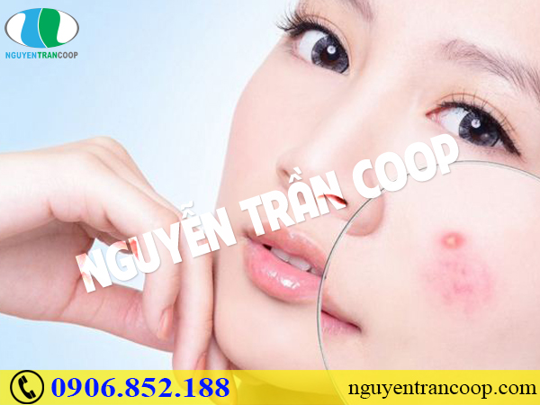 Cách trị mụn mủ không sẹo, không lây lan