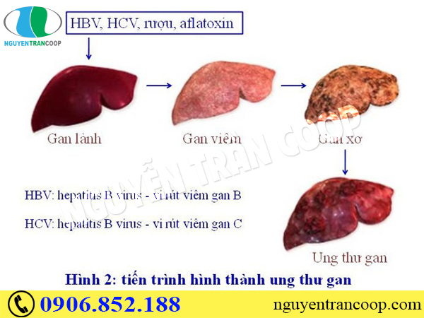 Cơ chế gây ung thư gan - Biết để phòng tránh