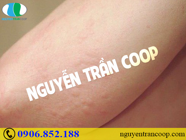 Đâu là dấu hiệu cần thải độc gan mà cơ thể “lên tiếng”?