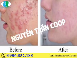 Điểm danh những cách trị mụn bọc hiệu quả nhất