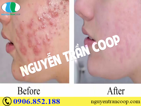 Điểm danh những cách trị mụn bọc hiệu quả nhất