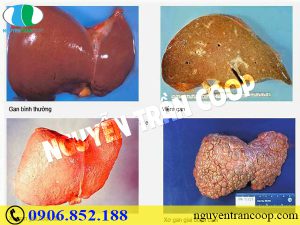 Những bài thuốc chữa xơ gan từ cây thuốc dân gian