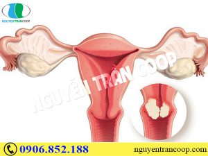 Những sự thật bạn cần biết về ung thư cổ tử cung
