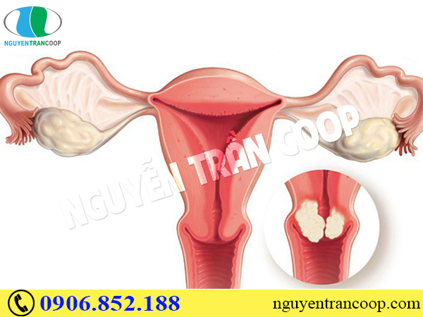 Những sự thật bạn cần biết về ung thư cổ tử cung