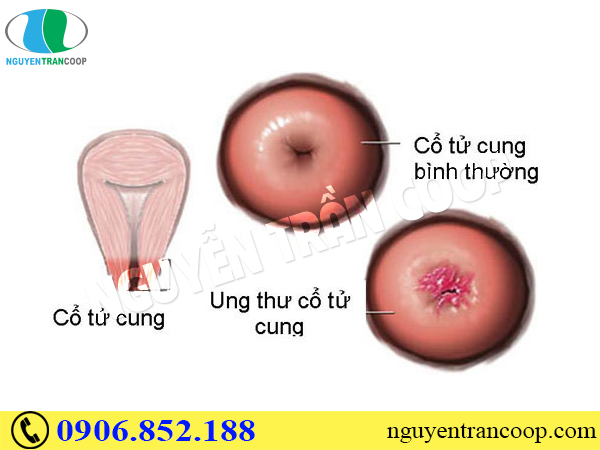 Những sự thật bạn cần biết về ung thư cổ tử cung