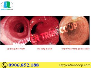 Phát hiện ung thư đại tràng giai đoạn đầu và cách chữa trị