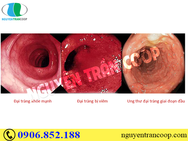 Phát hiện ung thư đại tràng giai đoạn đầu và cách chữa trị