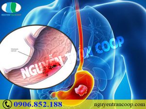 Phương pháp chữa ung thư dạ dày nào hiệu quả?