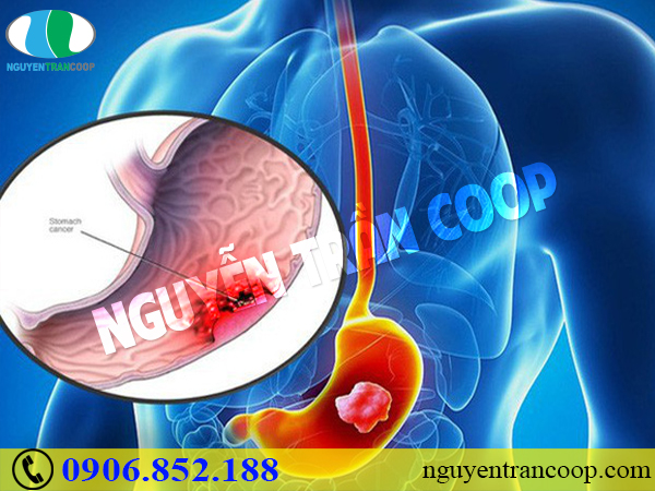 Phương pháp chữa ung thư dạ dày nào hiệu quả?
