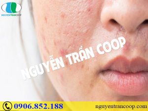 Sai lầm khi trị mụn trứng cá - Bạn có đang mắc phải không?