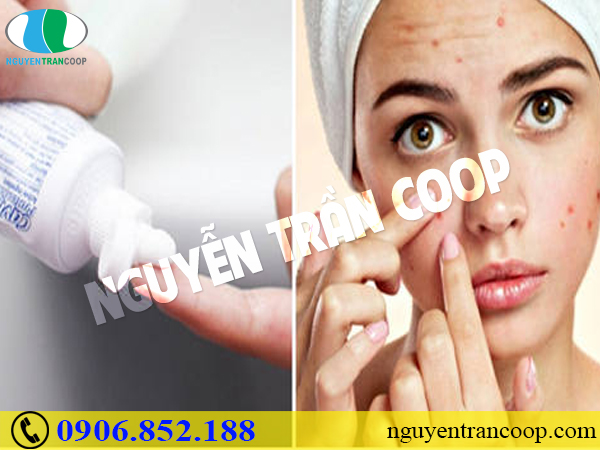 Sai lầm khi trị mụn trứng cá - Bạn có đang mắc phải không?