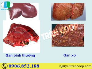 Thực hư Cây An Xoa chữa u xơ gan