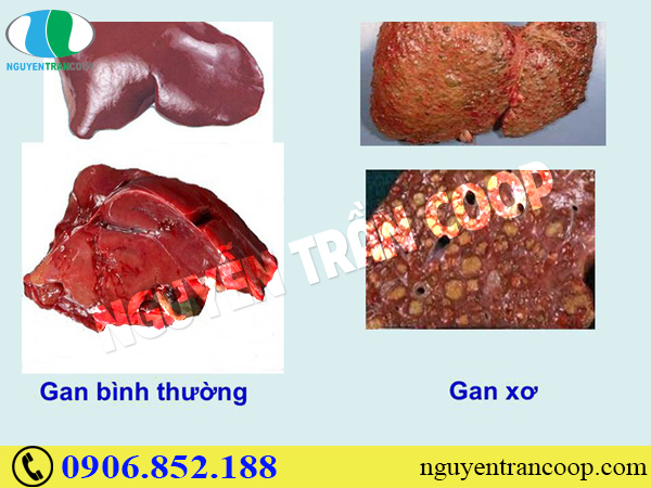 Thực hư Cây An Xoa chữa u xơ gan