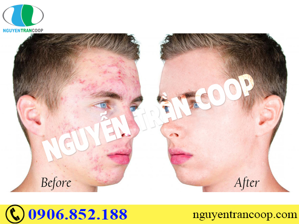 Bật mí thuốc trị mụn cho nam giới hiệu quả nhất