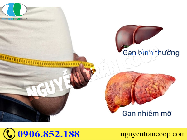 Biến chứng nguy hiểm của gan nhiễm mỡ giai đoạn cuối