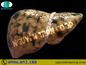 Biến chứng nguy hiểm của gan nhiễm mỡ giai đoạn cuối