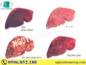 Sai lầm chết người khi chữa bệnh ung thư gan