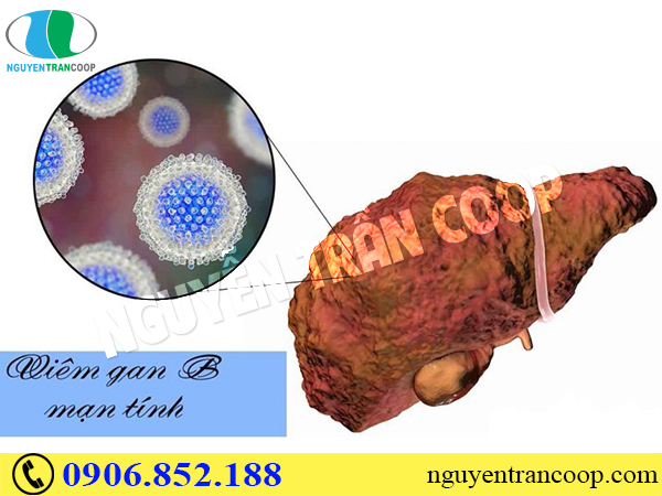 song-chung-voi-viem-gan-b-man-tinh-nhu-the-nao