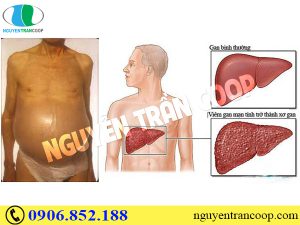 song-chung-voi-viem-gan-b-man-tinh-nhu-the-nao