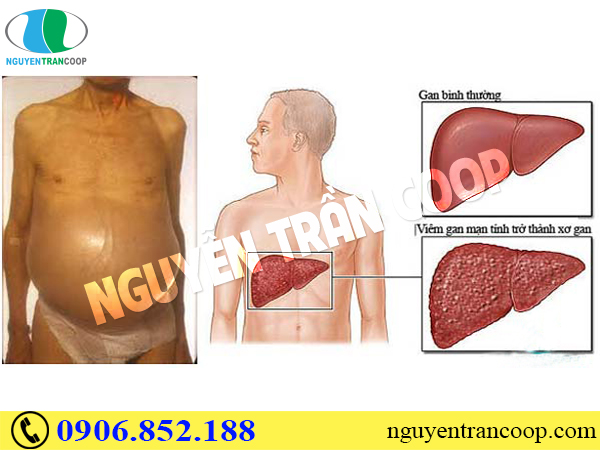 song-chung-voi-viem-gan-b-man-tinh-nhu-the-nao