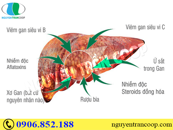 Bệnh ung thư gan có lây không - Nguyên nhân gây bệnh là gì?