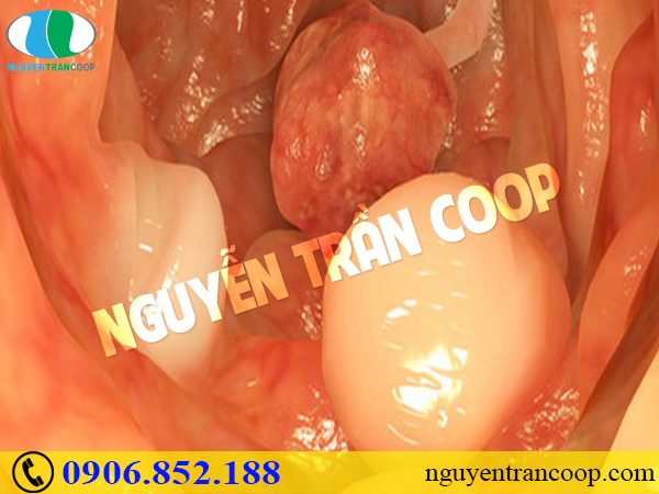 Chi phí chữa ung thư đại tràng hiện nay là bao nhiêu?