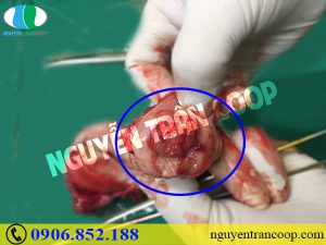 Chi phí phẫu thuật ung thư cổ tử cung có đắt không?