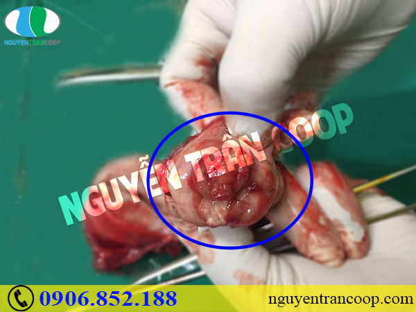 Chi phí phẫu thuật ung thư cổ tử cung có đắt không?