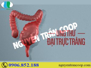 Đã tìm ra những cây thuốc chữa ung thư đại tràng hiệu quả
