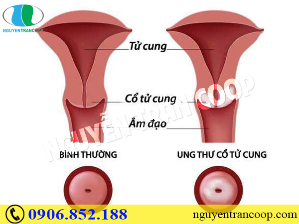 Nguyên nhân bất ngờ làm ung thư cổ tử cung tái phát