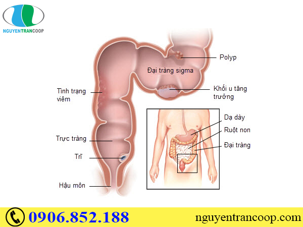 Nguyên nhân gây ung thư đại tràng ít ai ngờ đến