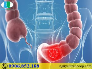 Nguyên nhân gây ung thư đại tràng ít ai ngờ đến