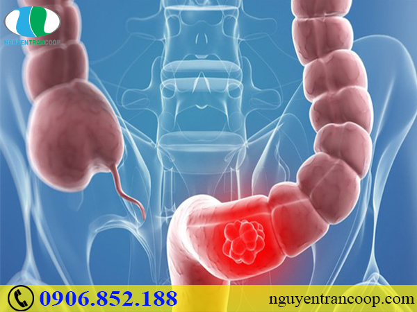 Nguyên nhân gây ung thư đại tràng ít ai ngờ đến