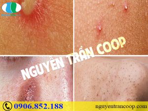 Nổi mụn vào mùa hè - Làm sao để mụn không kéo đến ồ ạt?