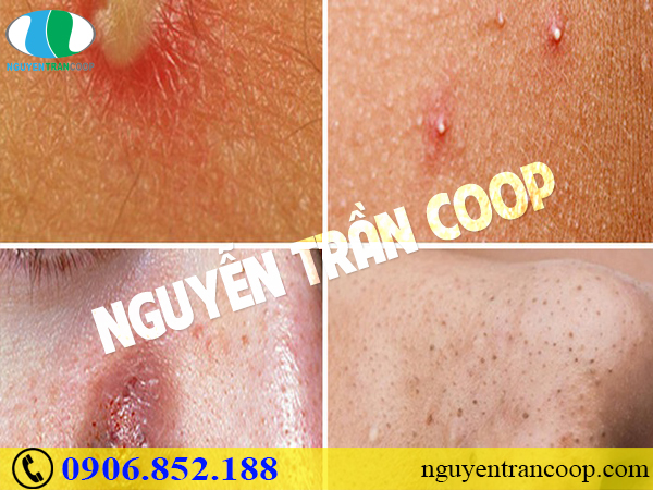 Nổi mụn vào mùa hè - Làm sao để mụn không kéo đến ồ ạt?