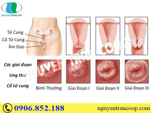 Ung thư cổ tử cung có mấy giai đoạn? Phát triển như thế nào?