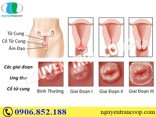 Ung thư cổ tử cung có mấy giai đoạn? Phát triển như thế nào?