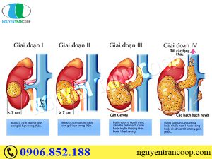 Ung thư gan có chữa được không?