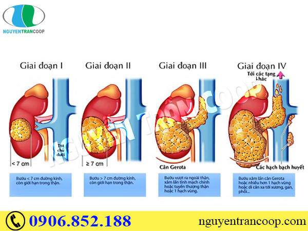 Ung thư gan có chữa được không?