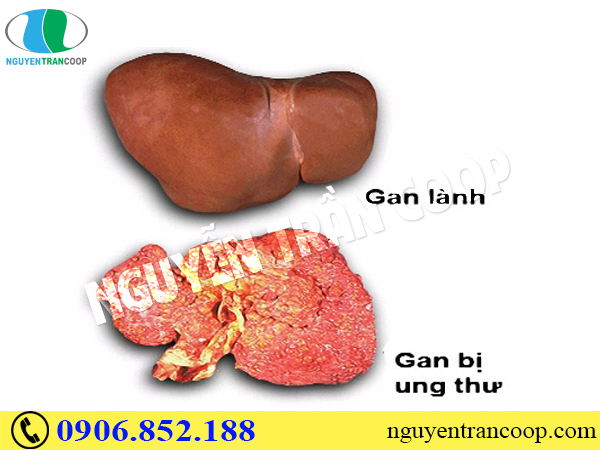 Ung thư gan có chữa được không?