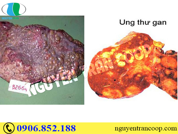 Ung thư gan di căn phổi nguy hiểm đến thế nào?